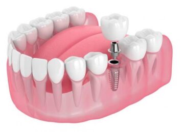 Стоит ли делать протезирование зубов?