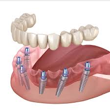 Рекомендации после имплантации зубов